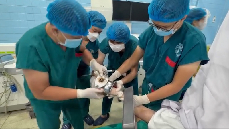 Nữ tiểu thương bị máy xay thịt cuốn nát bàn tay -0