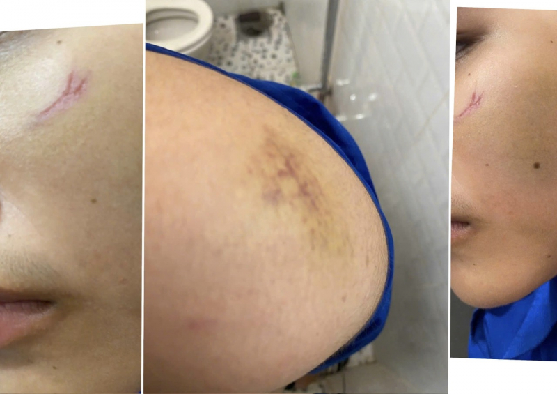 Nghĩ bị nẹt pô khiêu khích, 2 đối tượng chặn đường đánh nam sinh 16 tuổi -0