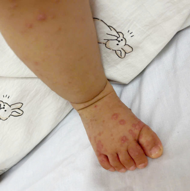 Bùng phát bệnh tay chân miệng, cảnh giác với những biến chứng nguy hiểm -0