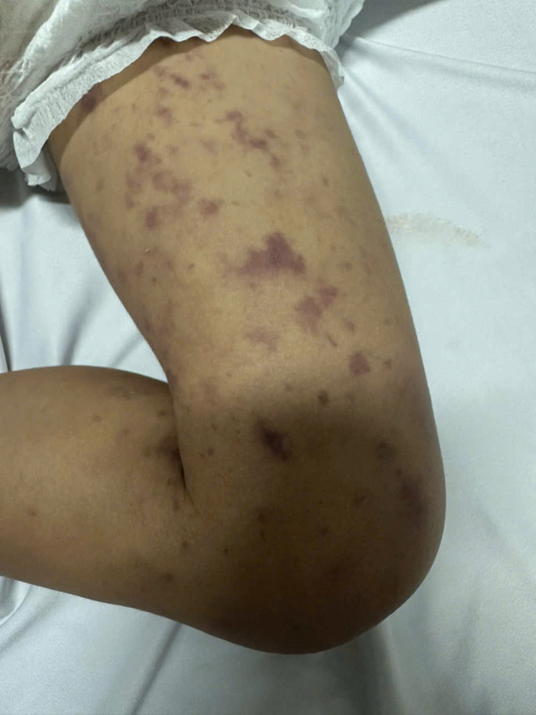 Đắk Lắk ghi nhận một bệnh nhi tử vong do bệnh viêm não mô cầu -0