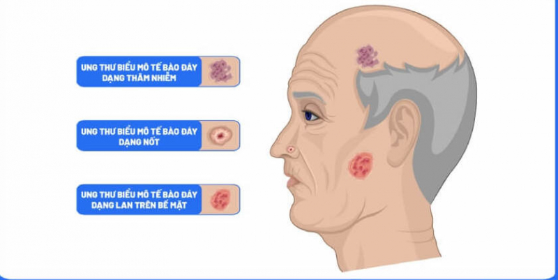 Nắng nóng cẩn trọng với căn bệnh ung thư da -0